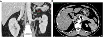 Case report: Percutaneous adrenal arterial embolization cures resistant hypertension